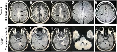 Case Report: Four Cases of Cortical/Brainstem Encephalitis Positive for Myelin Oligodendrocyte Glycoprotein Immunoglobulin G